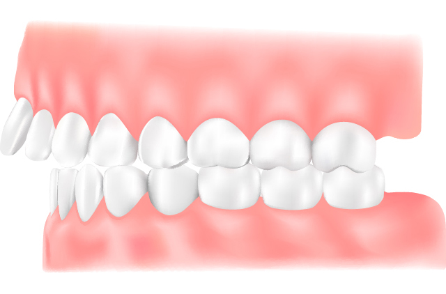 出っ歯（上顎前突）