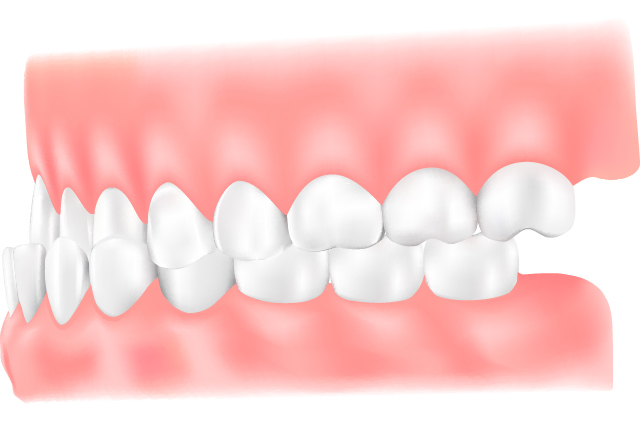 受け口（下顎前突）
