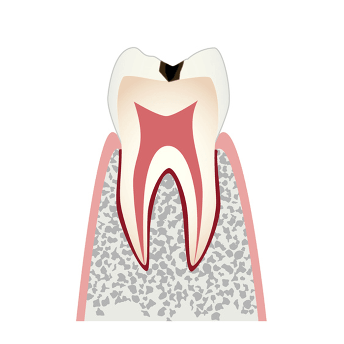 C1（エナメル質のむし歯）