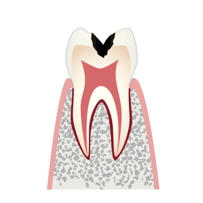 C2（象牙質まで進行したむし歯）