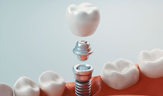 インプラント
